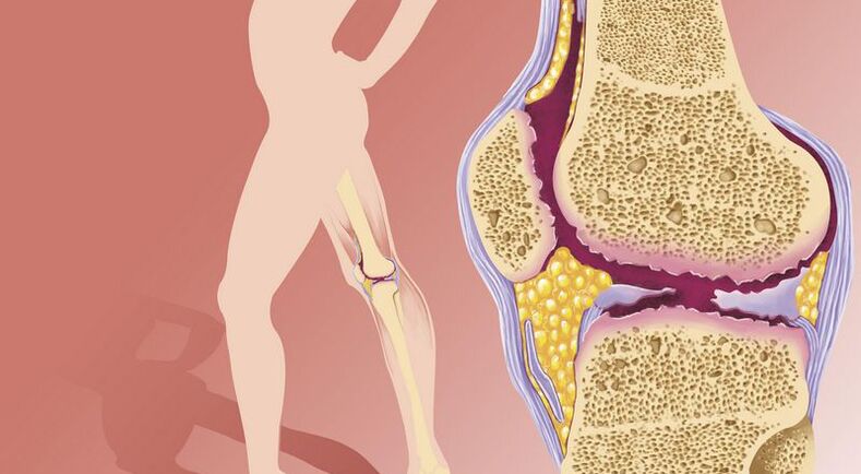 លើសទម្ងន់នាំឱ្យ arthrosis